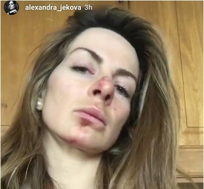 Ожулено лице синини и извадено рамо Българската сноубордистка Александра Жекова