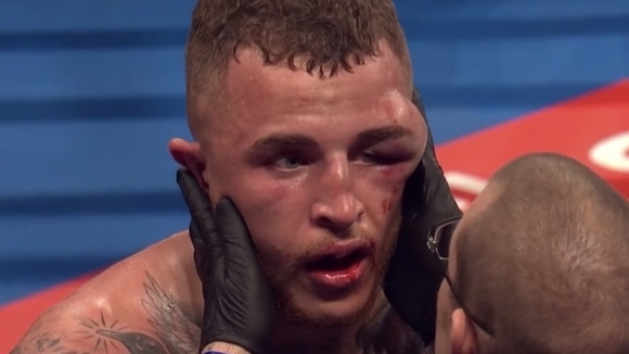 Огромна и ужасяваща подутина на лявото око на Сам Хайд