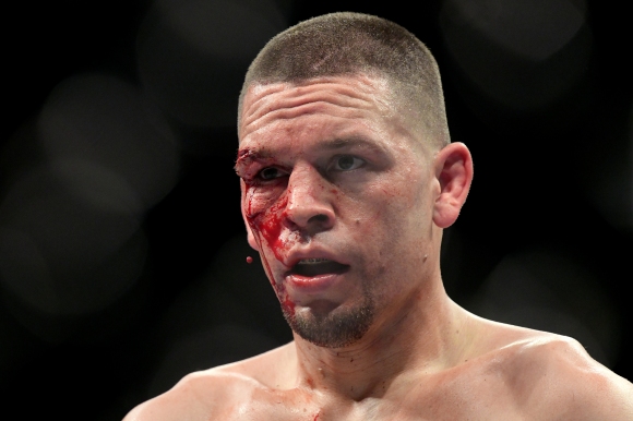 Една от най големите звезди на UFC Нейт Диас показа пораженията