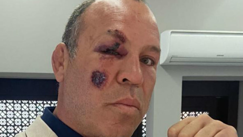 Легендарният ММА боец Вандерлей Силва е бил блъснат от автомобил